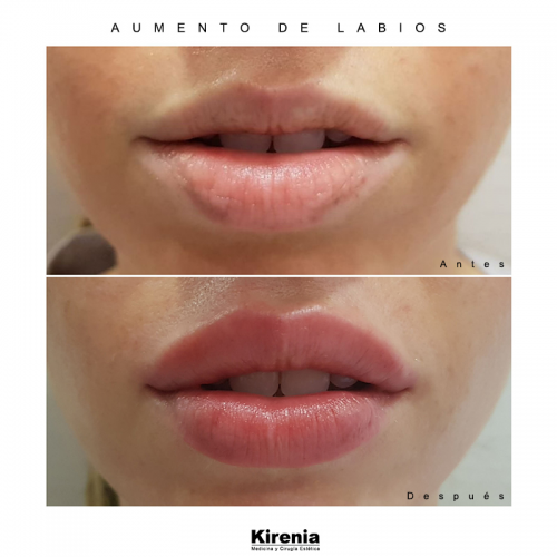 Relleno de labios